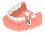 A dental implant being placed into the lower jaw of someone 's teeth.