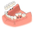 A cartoon of an upper jaw with teeth and implants.