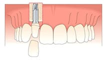 A tooth is being placed into the mouth of someone.