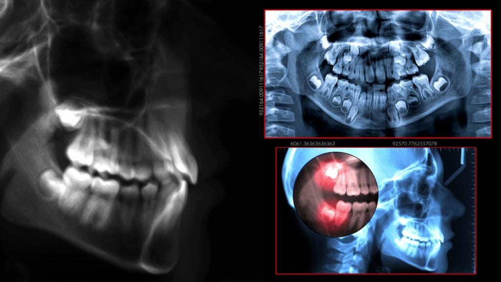 A picture of an x-ray and a photo of the teeth.